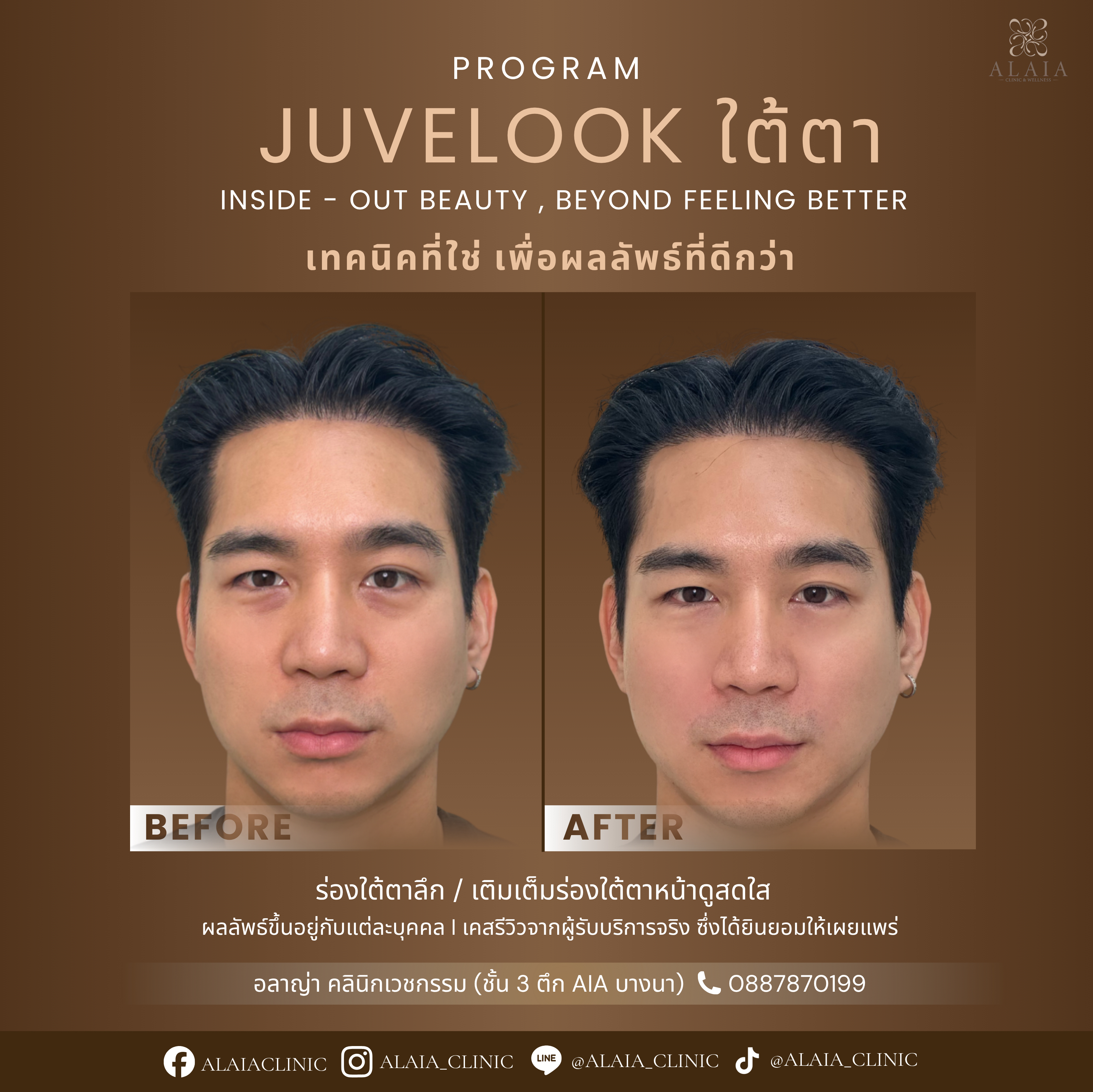 B&A 1